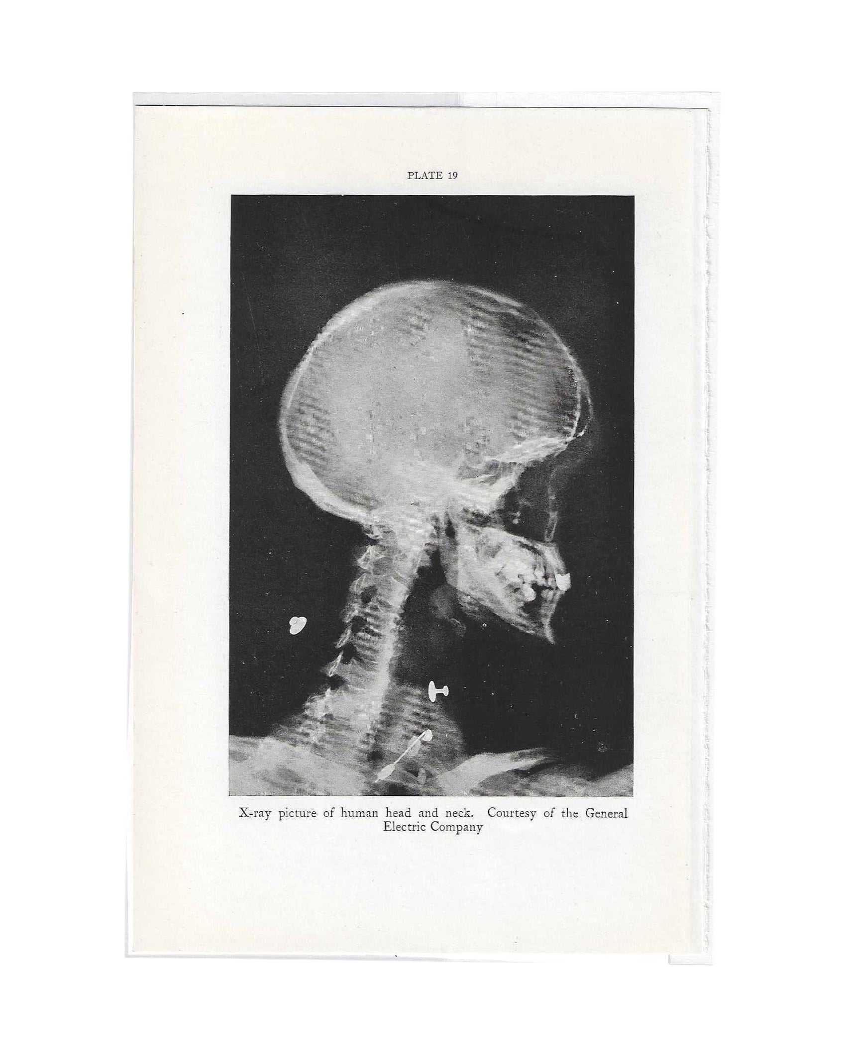 Vintage Skeleton X-Ray Lithograph, 1934