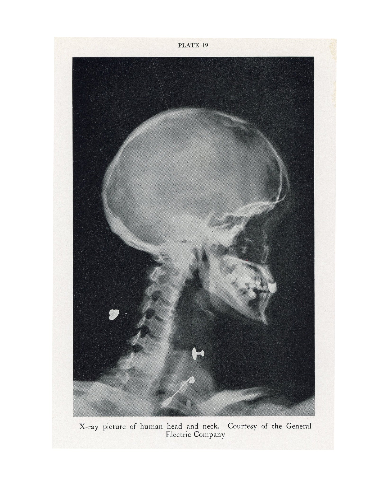 1934 Skeleton X-Ray – Original Vintage Lithograph